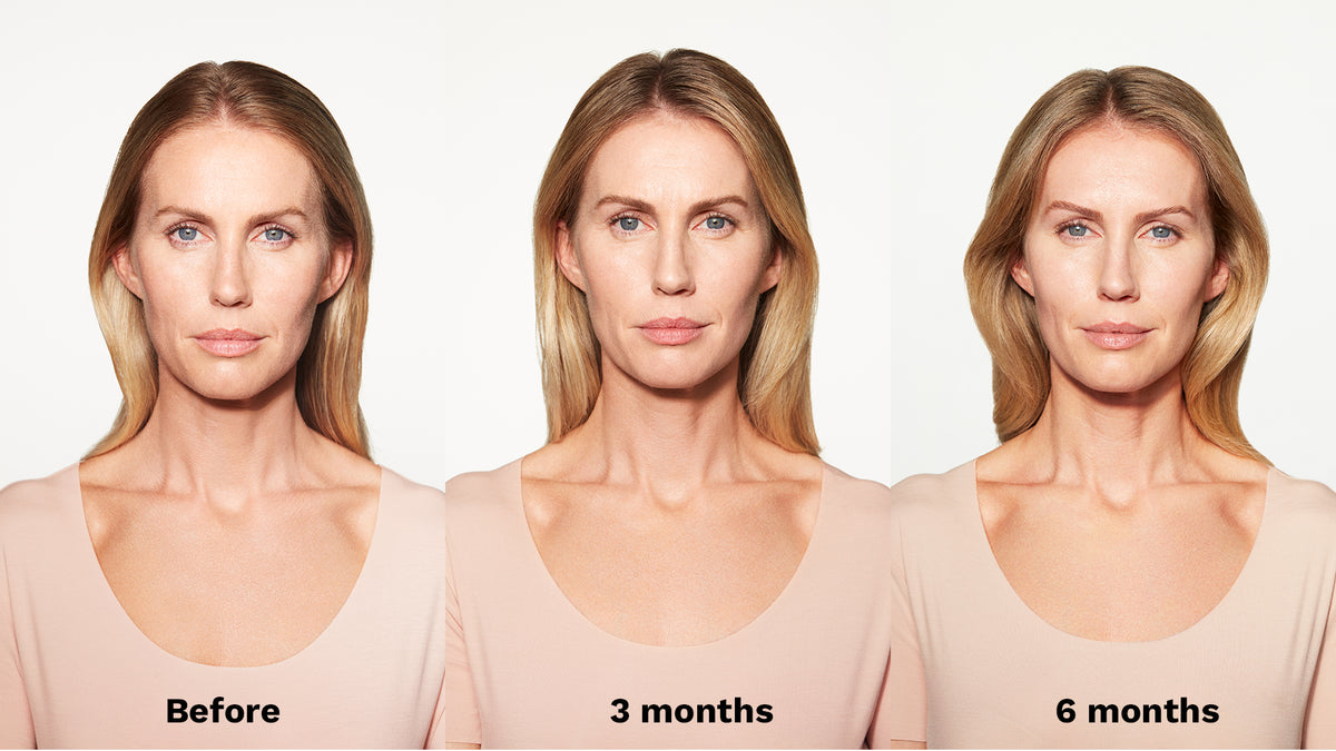 Sculptra